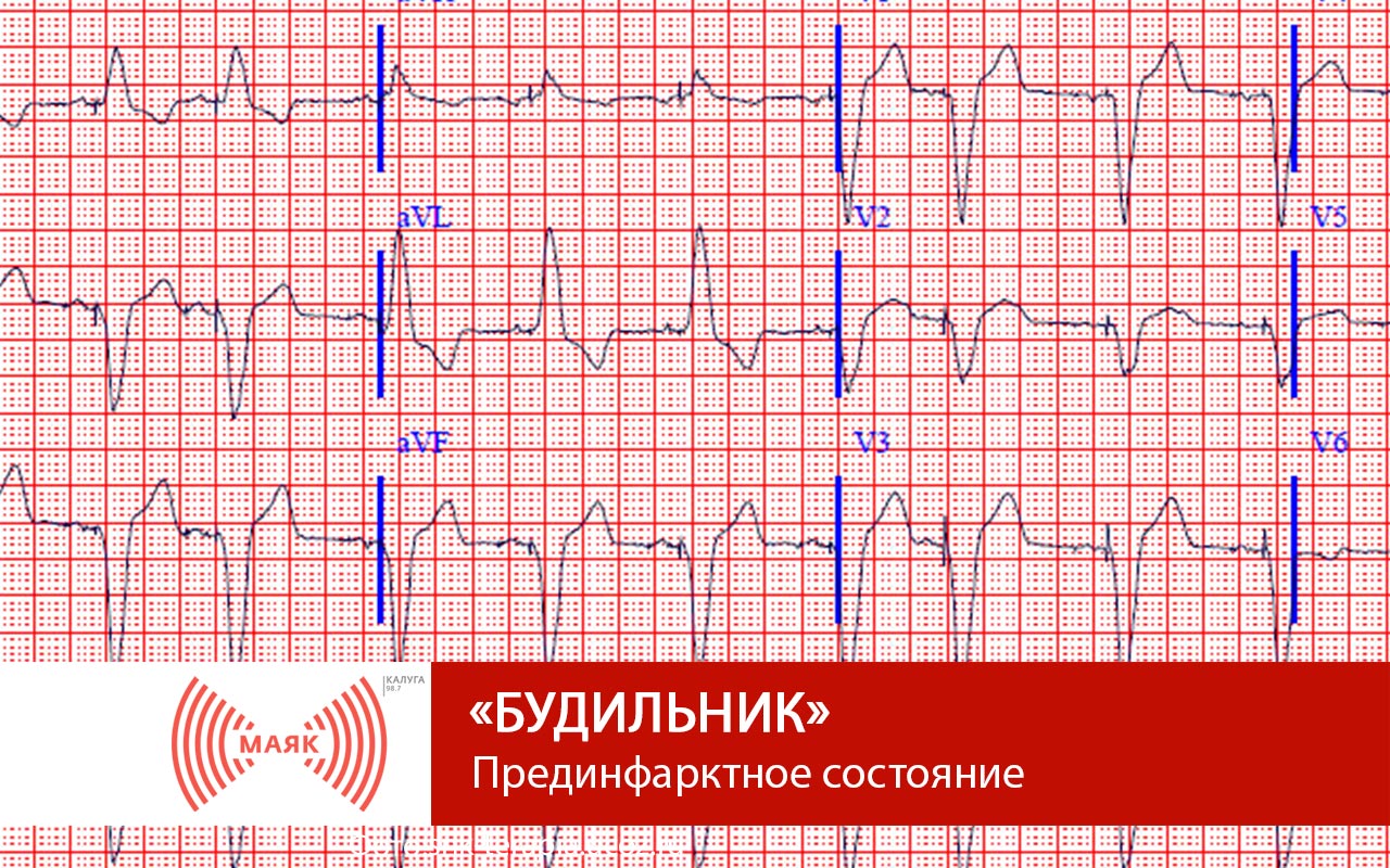 Предынфарктные симптомы у мужчин. Предынфарктная кардиограмма. Предынфарктное состояние на ЭКГ. Предынфарктная ЭКГ. Прединфарктное состояние на ЭКГ.