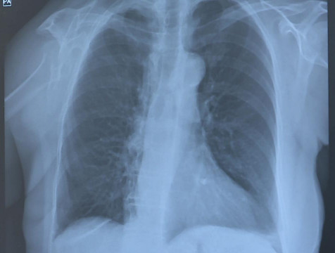 Минздрав предупредил о новой болезни, которую вызывают вейпы