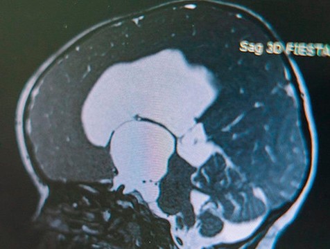 В честь Дня мозга калужанам напомнили о профилактике неврологических заболеваний