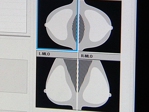 Калужанок приглашают пройти обследование на рак молочных желез