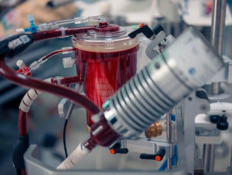 15 процедур с использованием ЭКМО провели калужские врачи